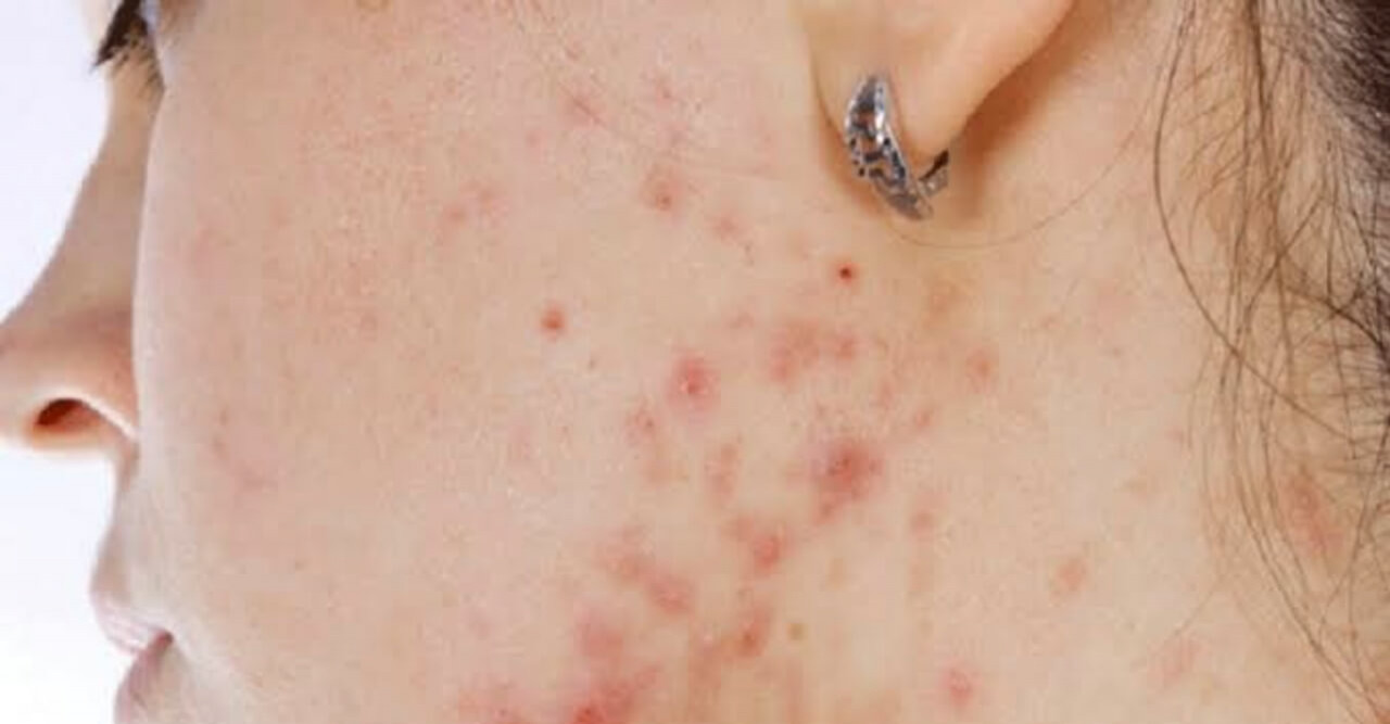 এলার্জি দূর করার উপায়